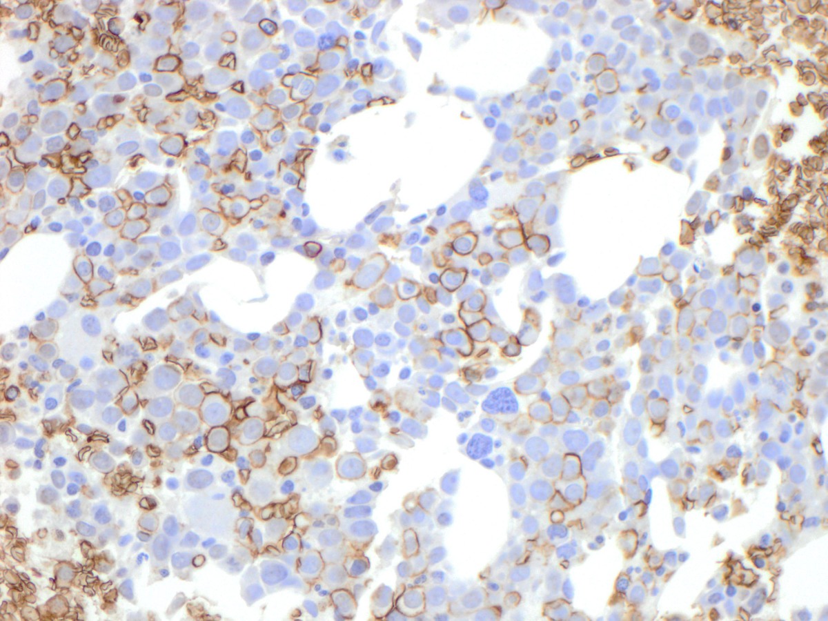 Immature cells are positive for Glycophorin A (400x)